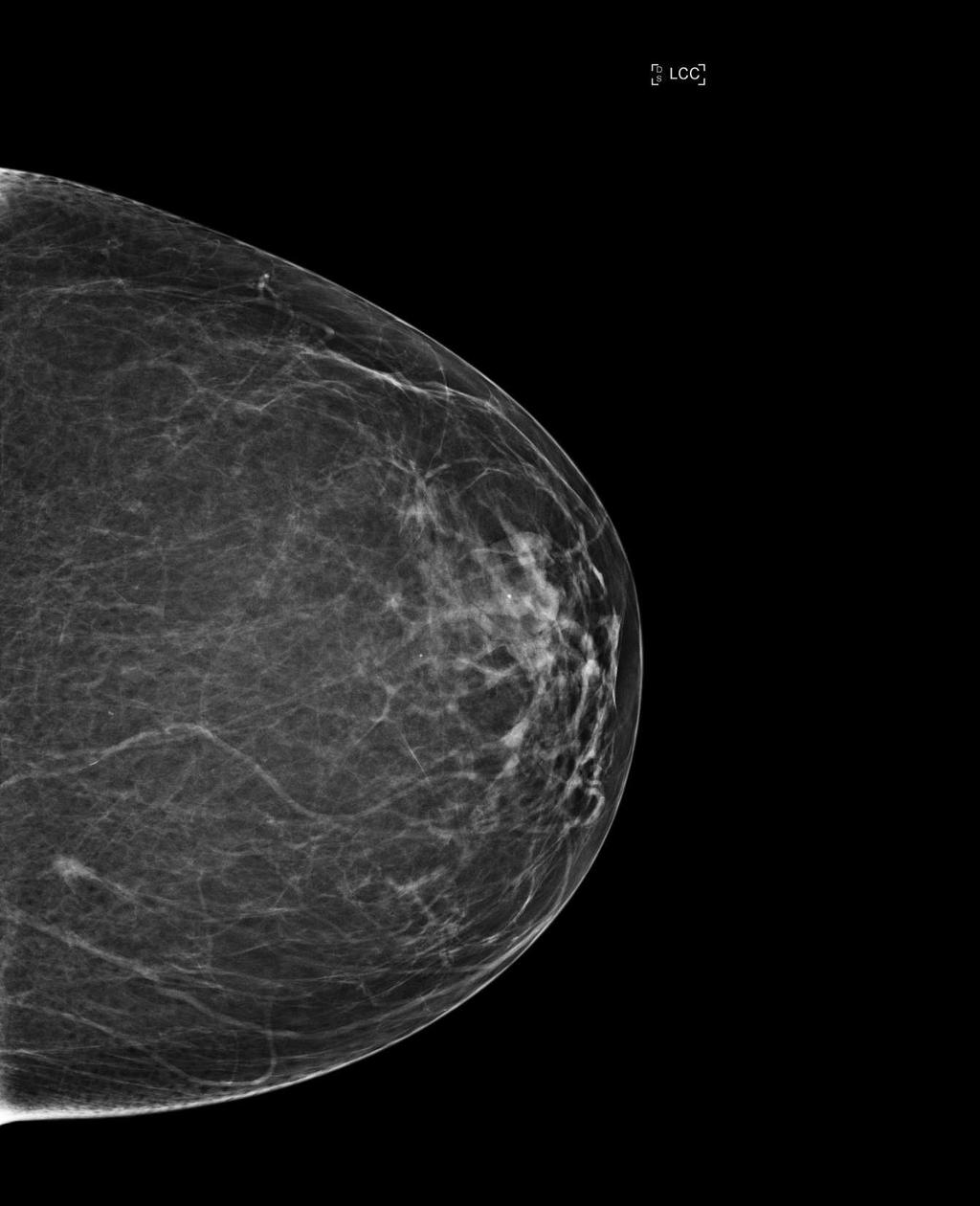 : Utilization of DBT with conventional mammography decreased recall rates for all patients and all breast densities Statistically significant decrease in recall rate for scattered, heterogeneously