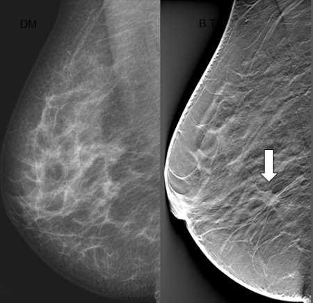 Applications of Tomosynthesis: Diagnostic Mammography Michel MJ et al.: The Area Under Curve (AUC) values for ROC demonstrated statistically significant (P= 0.