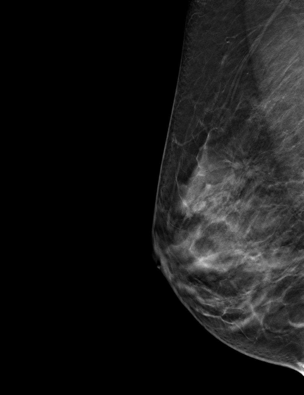 RMLO 3D Breast Tomosynthesis Slice 28 3D Breast