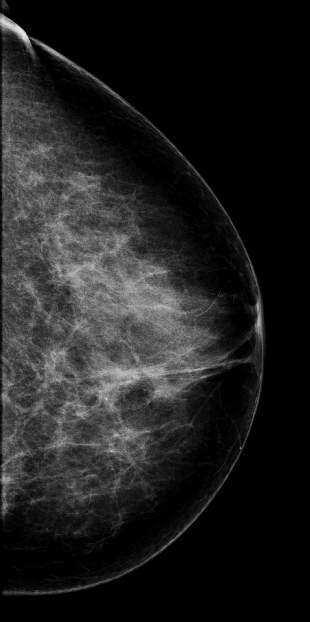 Image Interpretation Invasive Lobular Carcinoma Each generated image depicts the