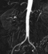artery aneurysm TR-MRA