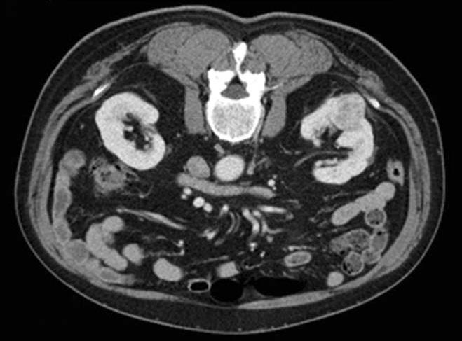 577) OR, odds ratio; CI, confidence interval. A B C D Fig. 2. Serial changes of a left renal tumor in local recurrence patient. (A) The preoperative computed tomography (CT) image showed a 3.