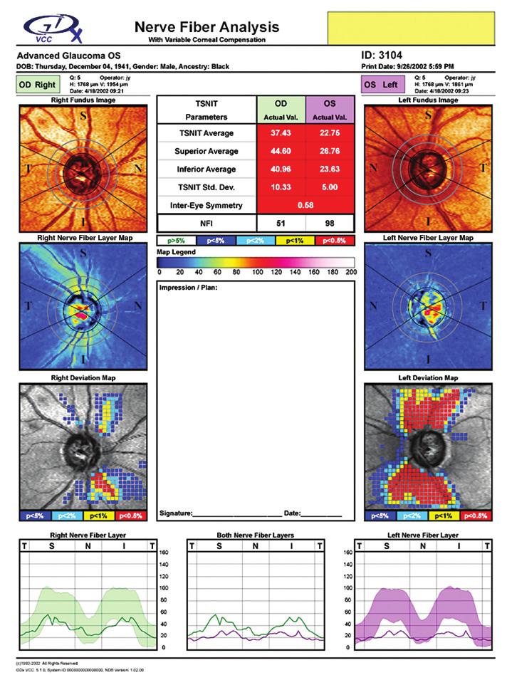 Nerve Fiber Analysis with Variable Corneal Compensation Objective, quantifiable measurements for early glaucoma detection TSNIT Parameters Measurements are obtained from the calculation circle