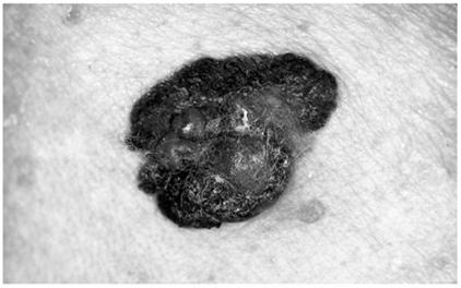 forming a concave ulcer - Chance of recovery good with early detection and surgical removal - Tends to metastasize to lymph nodes and may become lethal 6-55 Skin Cancer Copyright The McGraw-Hill