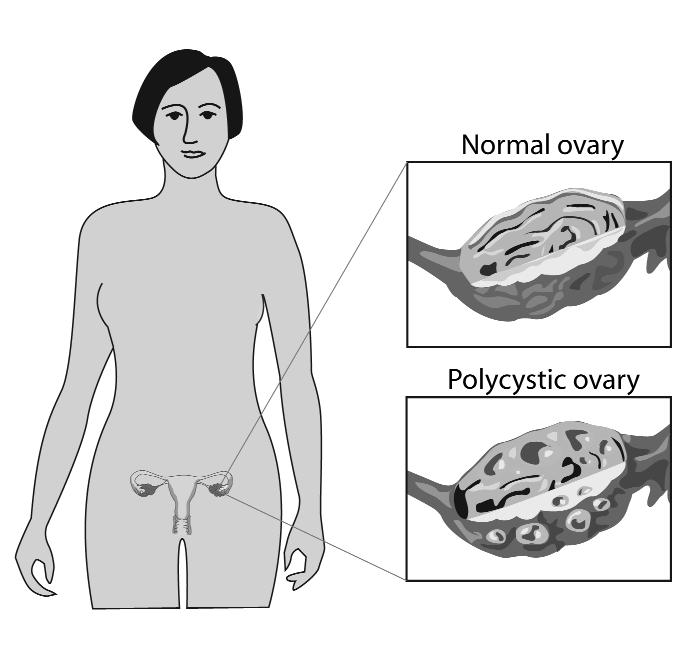 ovaries. Cysts are f luid-filled sacs. (PCOS) PCOS is the most common hormonal reproductive problem in women of childbearing age. Q: What is Polycystic Ovarian Syndrome (PCOS)?