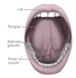 1 Oropharyngeal cancer begins in the part of the throat just behind the mouth and includes the back third of the tongue, the soft palate, the tonsils, and walls of the throat.