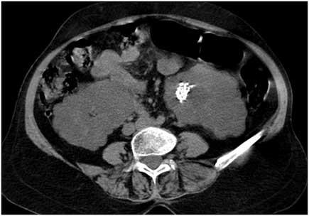 Figure 3. Non-contrast CT scan axial sections reveal multiple cysts in the liver and kidney.