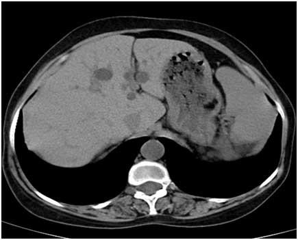 Non-contrast CT scan axial sections reveal multiple cysts in the liver and kidney.
