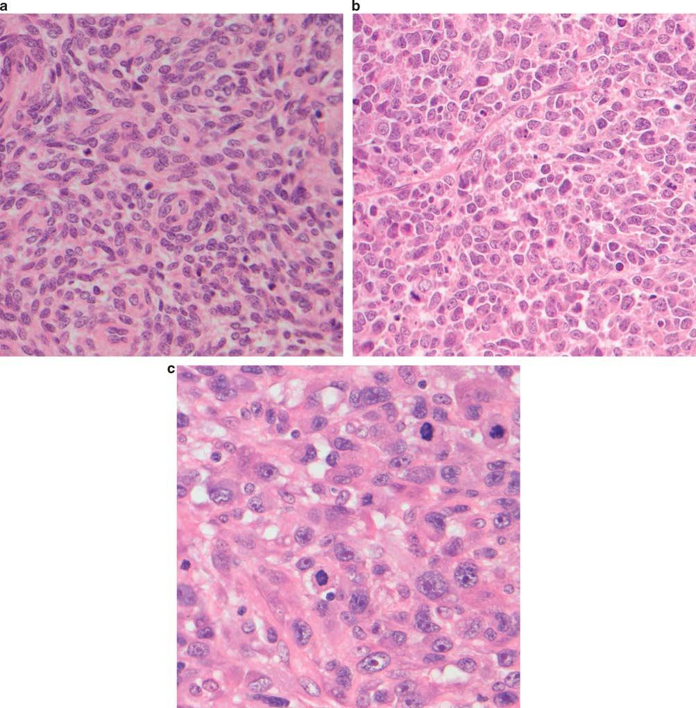 K Jakate et al 97 Figure 1 Hematoxylin and eosin stain, (a) low-grade endometrial stromal sarcoma, (b) undifferentiated endometrial sarcoma with nuclear uniformity, (c) pleomorphism. tumor.