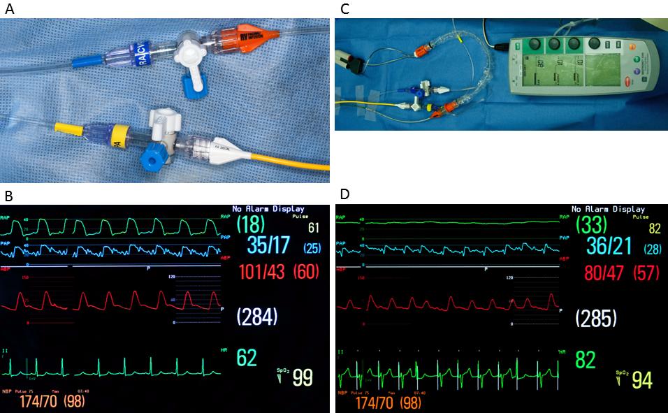 2 The Open Cardiovascular and Thoracic Surgery Journal, 2015, Volume 8 Wittwer et al. ventricular pacing at our institution from April 2008 until July 2014 were reviewed.