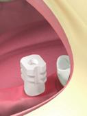 Taking the impression Components: Implant MF7-11375 Anatomic cementing transgingival