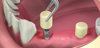 In this stage, it s possible to fabricate a cemented temporary crown or bridge on the anatomic cementing transgingival abutments.