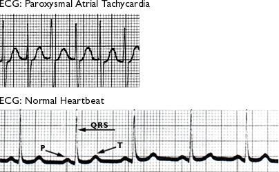 Supraventricular tachycardia (SVT) Quick rate between 300 and