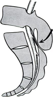 SPINA BIFIDA OCCULTA WITH ENGAGEMENT OF THE FIFTH LUMBAR SPINOUS PROCESS A Cause of Low Back Pain and Sciatica CARLOS E.
