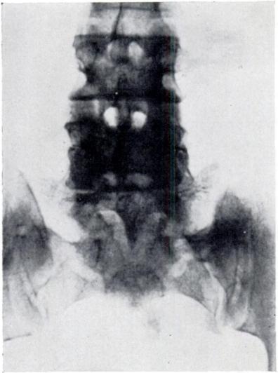 488 C. E. DE ANQUIN FIG. 3 CLINICAL A radiograph of an unusual spina bifida occulta. The operative findings suggested that pain was being produced at this site.
