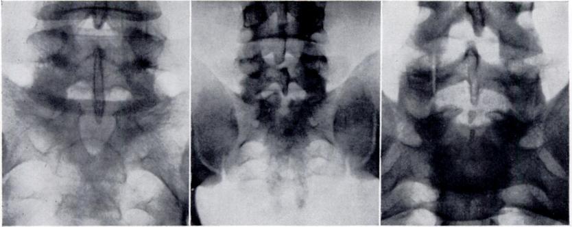 SPINA BIFIDA OCCULTA WITH ENGAGEMENT OF THE FIFTH LUMBAR SPINOUS PROCESS 489 projecting over it; in type 2 the breach is small and the spinous process engages the stumps of the spina bifida; in type