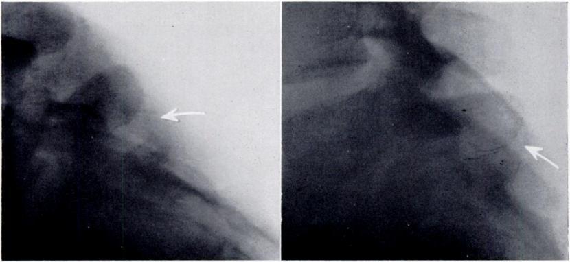 Lateral radiographs should also be taken with the patient standing in flexion and extension, to show the impingement of the fifth spinous process on the spina bifida (Figs. 7 and 8). FIG. 4 FIG.