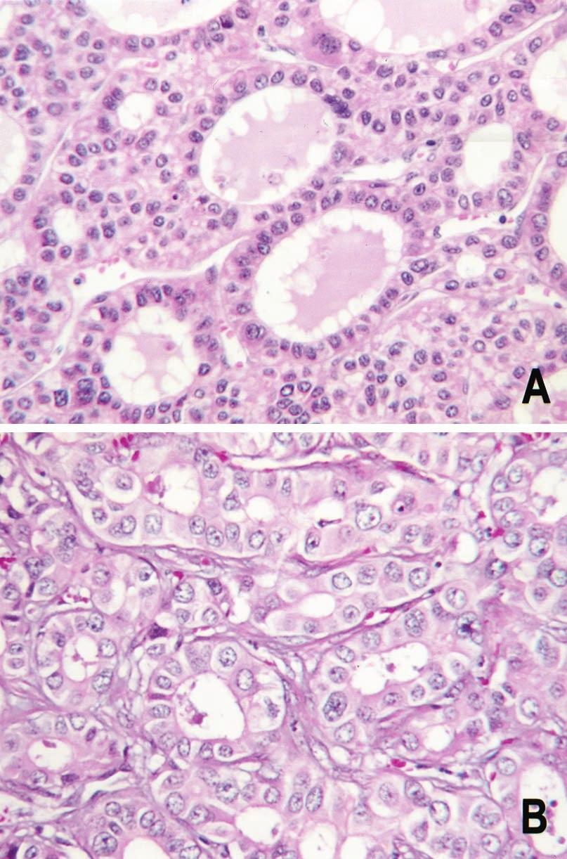 FIGURE 1. A, hepatocellular carcinoma, pseudoalveolar pattern (hematoxylin and eosin, 320). B, cholangiocarcinoma (hematoxylin and eosin, 320).