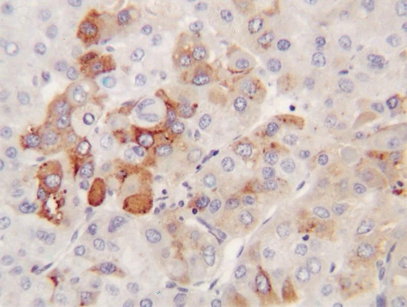 In addition, the pseudoalveolar HCC showed luminal staining in addition to a focal canalicular pattern (five cases; Fig. 4D). CK 7 stained 4 of 13 HCC, 13 of 14 CC, 3 of 3 HCC-CC, and 15 of 27 MA.