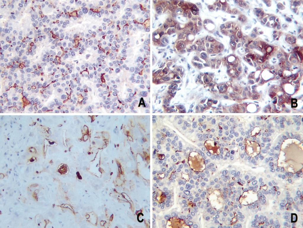 FIGURE 4. A, hepatocellular carcinoma, canalicular pattern of staining with polyclonal carcinoembryonic antigen (pcea) (anti-pcea with hematoxylin counterstain, 320).