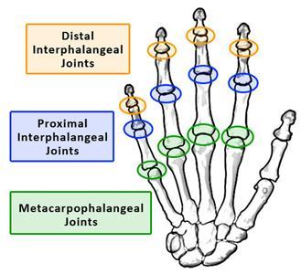 Analyzing Hand Therapy Success in a Web-Based Therapy System 3 the thumb DIP and finally one for the thumb PIP. The hand joint angles name is shown in Figure 2.