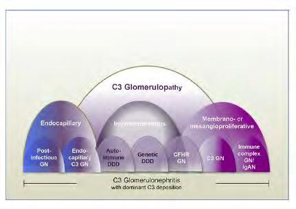 Spectrum of C3 nephropathy From