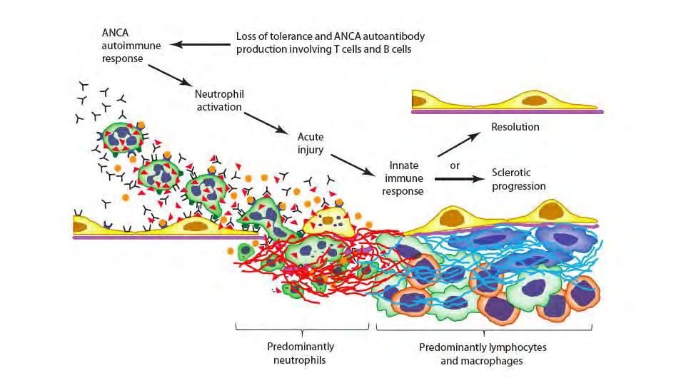 ANCA-associated vasculitis: the