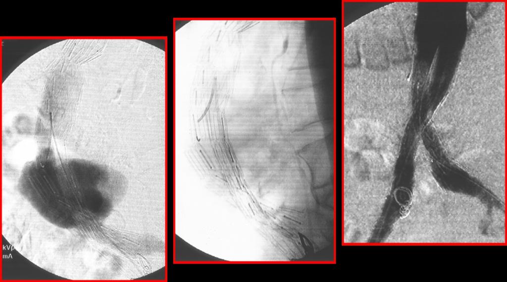 Fig. 6: Digital subtraction angiogram of junction attachment site endoleak treatment (type III). First Image, on lateral projection, extensive junction attachment site endoleak is seen.
