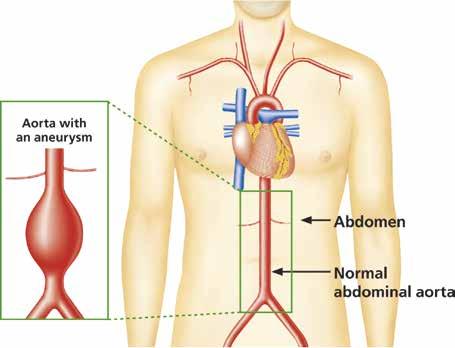 What is an AAA? The aorta is the main artery that supplies blood to your body. It runs from your heart down through your chest and abdomen (stomach).
