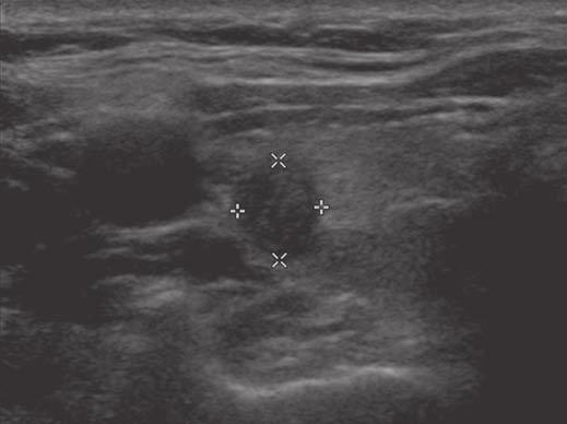 Moon et al. Fig. 1 Papillary thyroid carcinoma in 42-year-old woman.