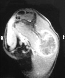 This case was managed by orthopaedic surgeons and radiologists specialized in musculoskeletal oncology. It was decided to proceed to surgical treatment without making a preliminary biopsy.