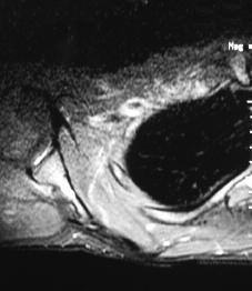 DISCUSSION Herein, we describe a case of a large ABC situated in the scapula of a 15 year-old male. This case is interesting because tumours of the scapula are rare and usually malignant (22).
