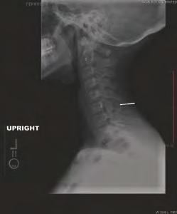 Chondromyxoid Fibroma With Secondary Aneurysmal Bone Cyst in the Cervical Spine* CASE REPORT Brian R. Subach, M.D., F.A.C.S. Anne G. Copay, Ph.D. Marcus M. Martin, Ph.D. Thomas C. Schuler, M.D., F.A.C.S. Maritza Romero-Gutierrez, M.