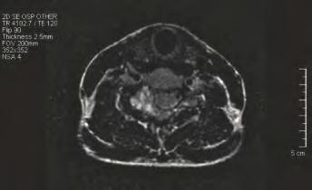 T1-weighted axial MRI with gadolinium demonstrating a homogenous pattern of enhancement in the C6 lamina and right lateral mass.
