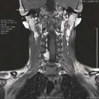 A chest radiograph (negative) and nuclear medicine bone scan were performed to rule out metastatic disease finding only abnormal signal uptake in the lower cervical spine.