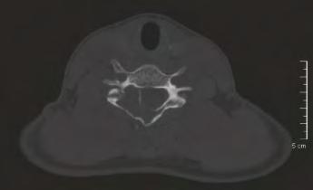 Computed tomography (CT) demonstrating evidence of a hypodense lesion causing diffuse expansion of the right C6 lamina with extension through the anterior cortex into the epidural