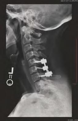 Figure 6. Lateral cervical radiograph demonstrating a posterior cervical arthrodesis with lateral mass screw fixation in anatomic alignment. with abundant myxoid or chondroid intercellular material.