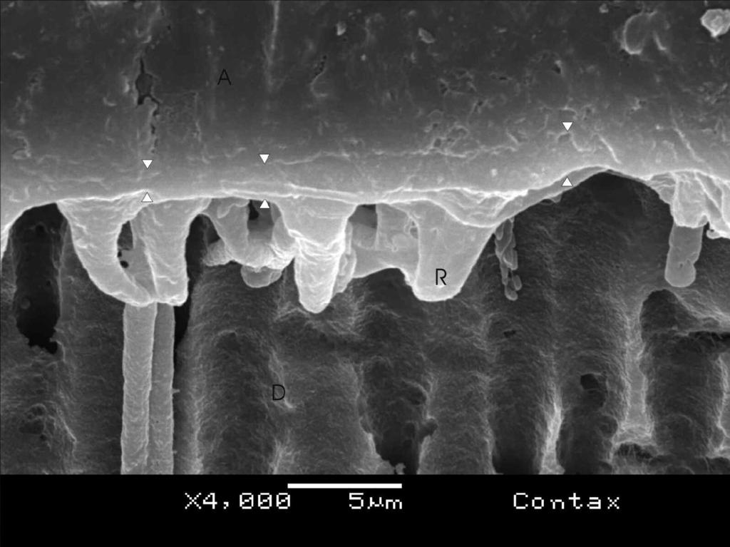 Figure 4. SEM resin-dentin interface formed by Contax. A hybrid layer ranging from 1-2 µm is visible (between arrowheads). A: adhesive. R: resin tag. D: dentin. Figure 5.