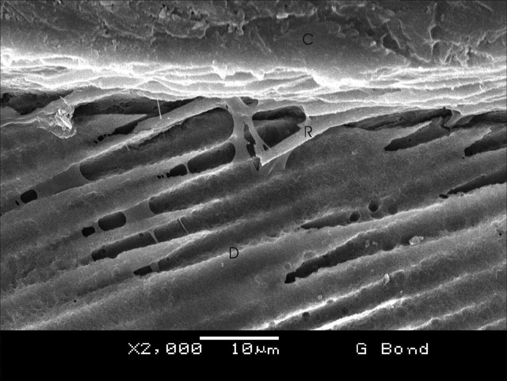 714 Operative Dentistry Figure 7. SEM micrograph of a mild 1-step 1-component adhesive G- BOND (GC Corp) interface with dentin. Resin tags formation is minimal. C: composite resin. R: resin tag.
