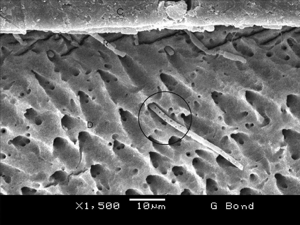 A larger magnification of the area in circle on Figure 8. Voids in the resin tag (arrows) are a result of water droplet evaporation during specimen preparation for SEM.