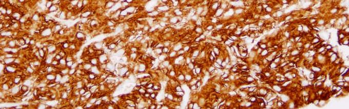 Keratin - NE tumors, RCC Urothelial CA Squamous cell carcinoma
