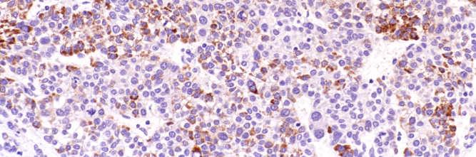 adenocarcinomas: -ve Polygonal cell tumors: -ve Hep Par 1 in HCC Hep Par 1 in HCC Pitfalls in diagnosis Focal