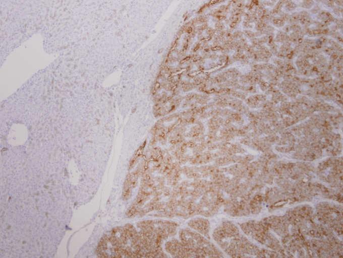 Other hepatocellular markers AFP CD10,villin: canalicular pattern TTF-1: cytoplasmic staining CD34 Albumin in situ hybridization HCC immunohistochemistry Adenocarcinoma markers MOC-31 CK7, CK19 Site