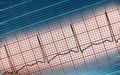 Myocardial damage Myocardial damage is essentially damage to the heart muscle. The sort of damage that occurs from a heart attack.