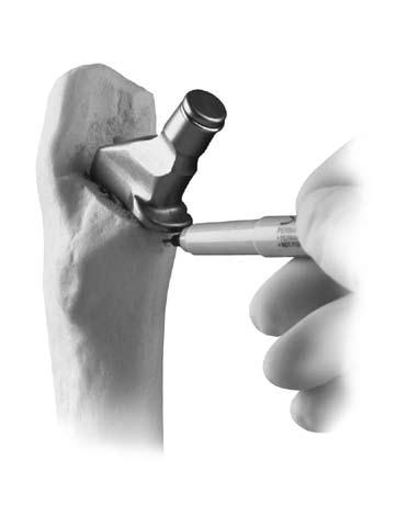 8 Versys Advocate V-Lign and Non V-Lign Cemented Hip Prosthesis If not using the V-Lign Stem, use the center line mark on the provisional to make a visual mark on the calcar bone (Fig. 17).