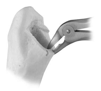 The Femoral Head is placed on the taper with a twisting motion until it locks on the taper. One sharp strike using the Femoral Head Impactor and mallet is performed to seat the Femoral Head.
