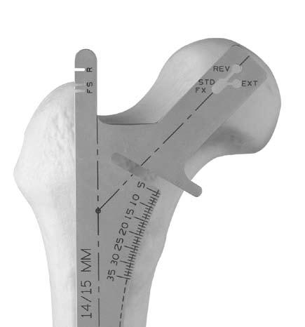 Versys Advocate V-Lign and Non V-Lign Cemented Hip Prosthesis 3 Surgical Technique Incision and Exposure of the Hip Joint In total hip arthroplasty, exposure can be achieved through a variety of