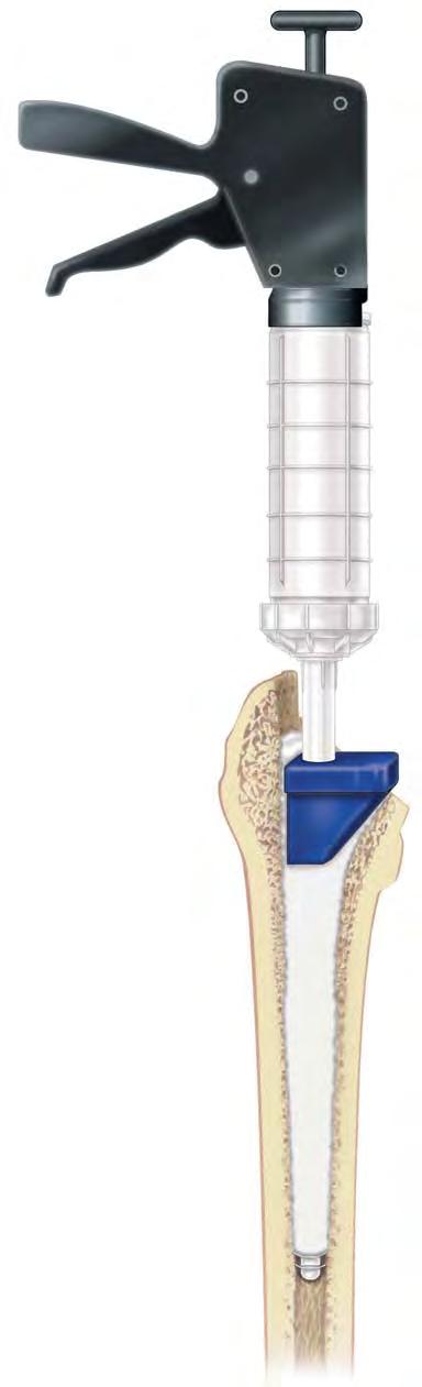 Pressurizing Cement 14. Pressurizing Cement Break off the long nozzle and place the femoral pressurizer over the short nozzle. Apply the disposable femoral pressurizer into the mouth of the canal.