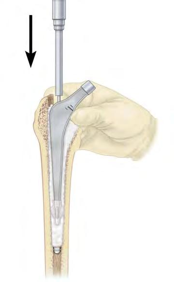 Stem Insertion 15. Stem Insertion Using clean gloves, place the distal centralizer over the distal tip of the stem by carefully pushing the centralizer superiorly until snug.