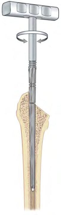 Femoral Canal Preparation 3.